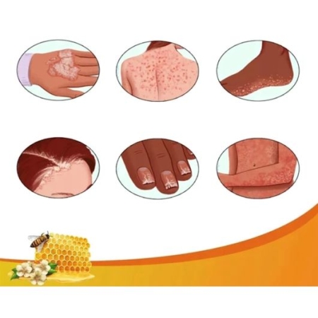 PROFESJONALNY krem do leczenia na ŁUSZCZYCĘ swędzenie z JADEM PSZCZELIM 20g